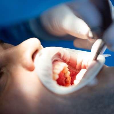 Cirurgia Oral Menor (cirurgia dentárias)